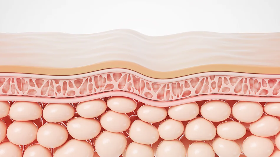 Schematische Darstellung der Hautschichten mit Dermis und Unterhautfettgewebe 