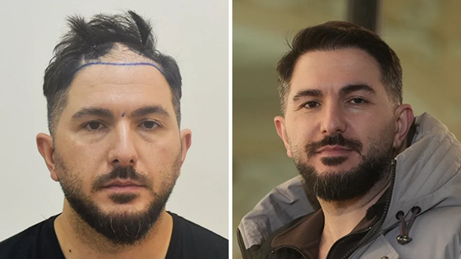 Vorher nachher DHI Haartransplantation mit 4200 Grafts bei Patient Onur Y