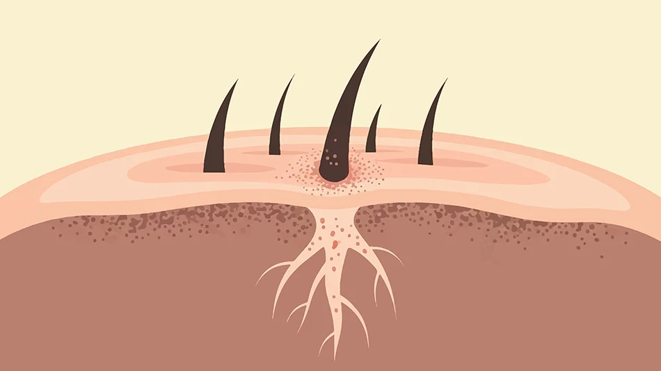 Illustration eines Haarfollikels in der Kopfhaut mit sichtbarer Haarwurzel und umliegendem Gewebe.