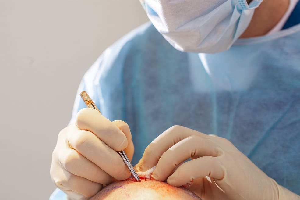 Postoperative Narben sind nur selten nach der Haartransplantation sichtbar Arzt nimmt eine Haartransplantation sichtbar am kahlen Kopf eines Patienten vor
